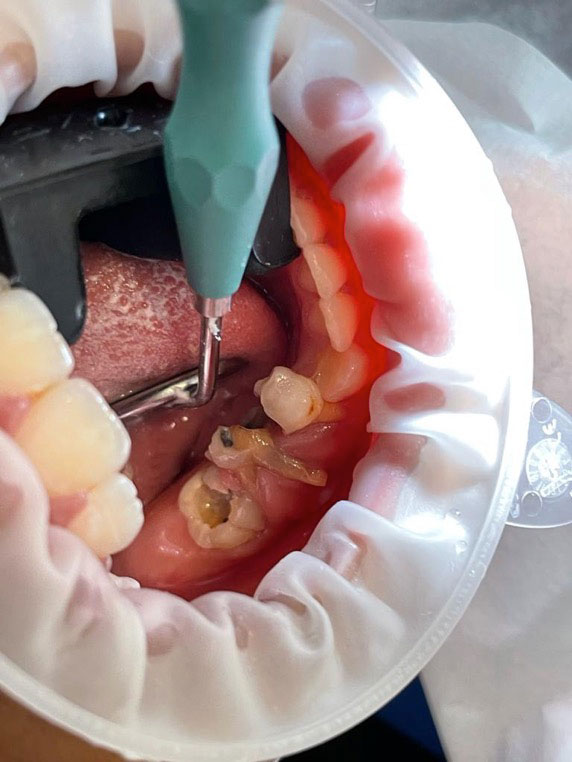 Dentist-Kambodscha-Charity-Education-Rotten-Teeth-2