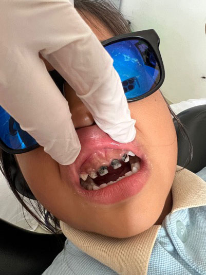 Dentist-Kambodscha-Charity-Education-Rotten-Teeth